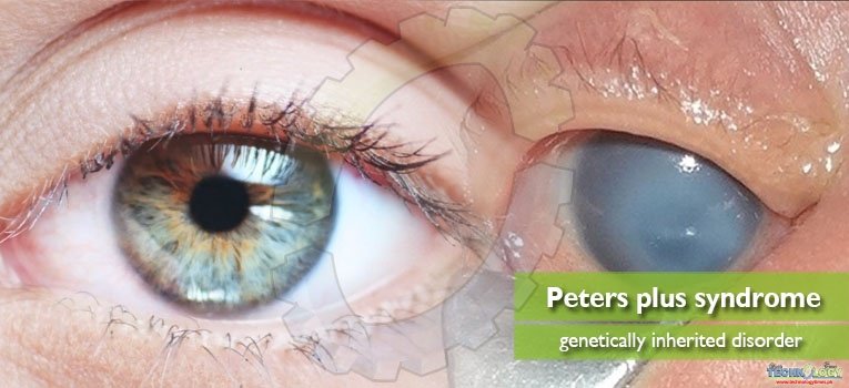 Peters plus syndrome – genetically inherited disorder