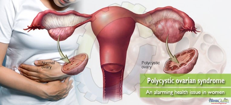 Polycystic ovarian syndrome – An alarming health issue in women