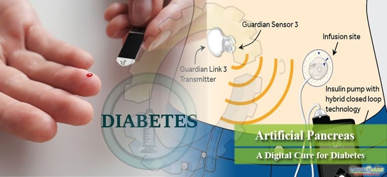 Artificial Pancreas: A Digital Cure for Diabetes