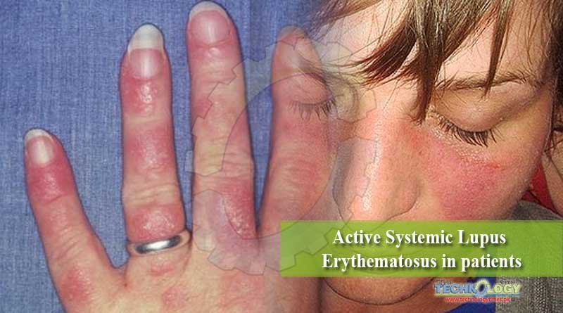 Active Systemic Lupus Erythematosus in patients