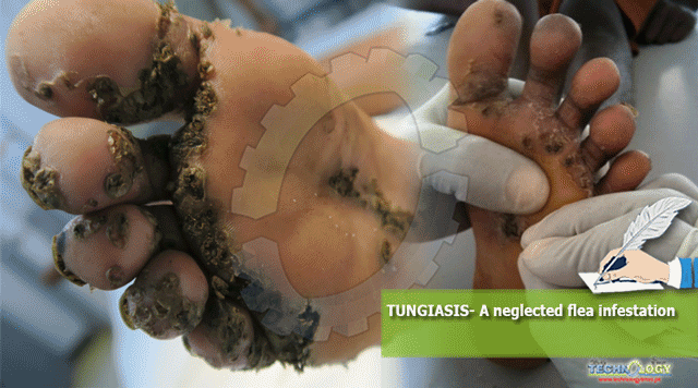 TUNGIASIS-A-neglected-flea-infestation