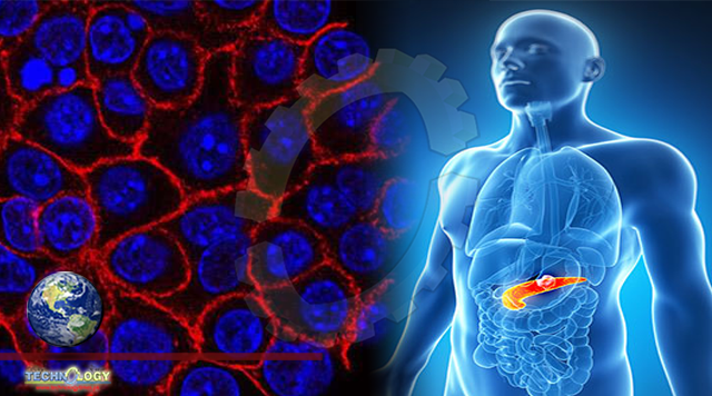 Study identifies biomarker that could help to diagnose pancreatic cancer