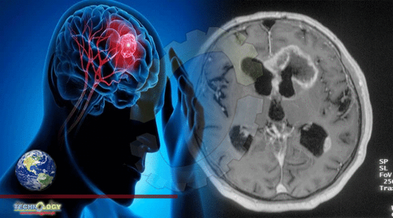 Scientists understands brain tumor biology for better cure options