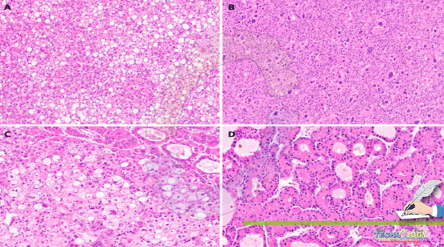 Hepatocellular-Carcinoma-HCC-An-Update-with-Reference-to-Diagnosis-and-Treatment.