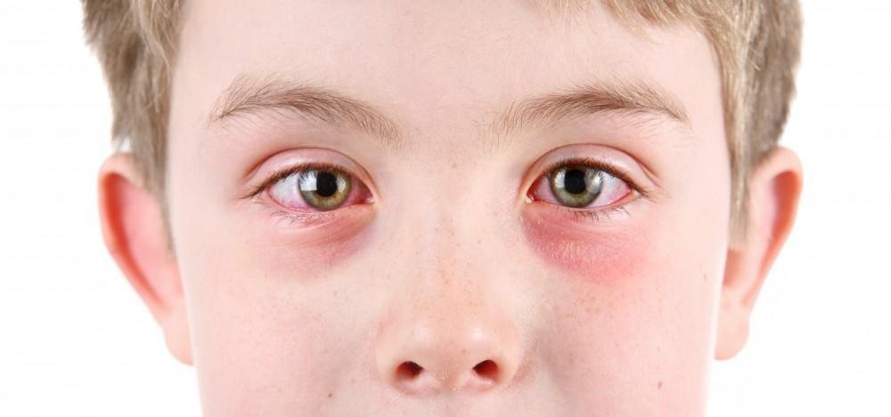 Catchy, Not Contagious? Learn the Truth About Pink Eye